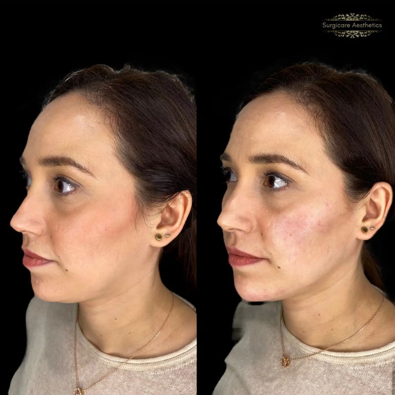 Before and after cheek filler in Birmingham
