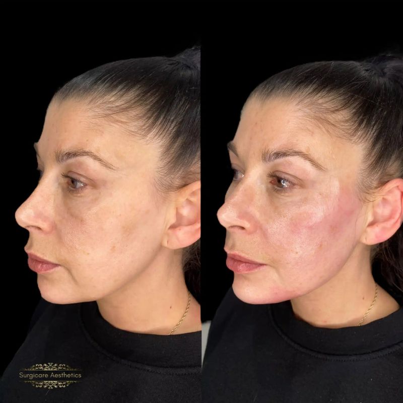 Before and after cheek filler in Birmingham