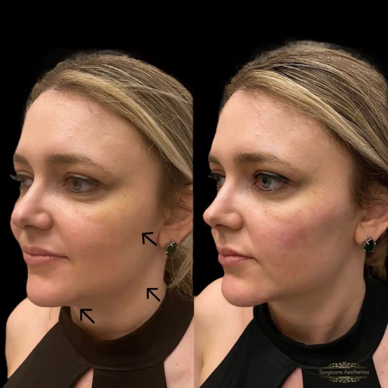Before and after cheek filler in Sutton Coldfield 