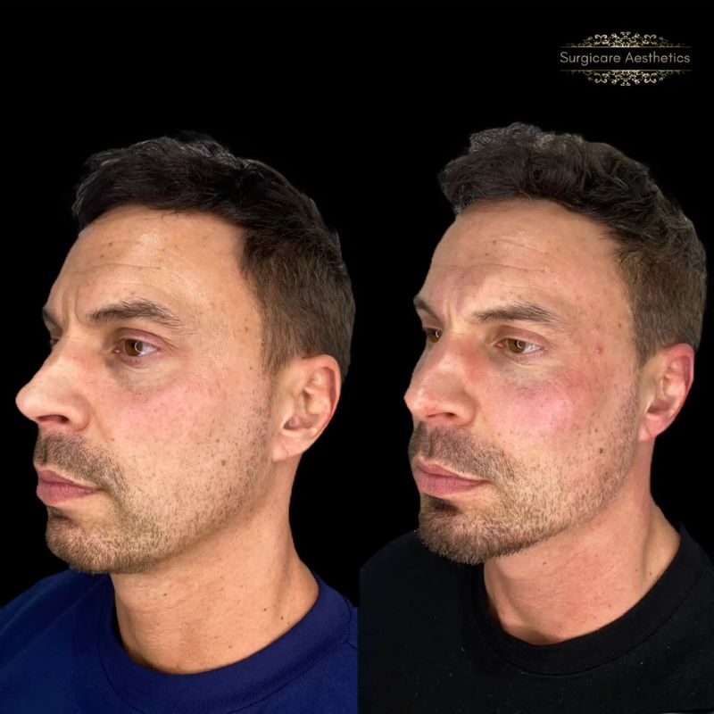 Before and after cheek filler in Birmingham