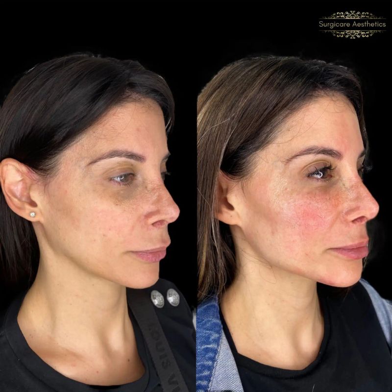 Before and after cheek filler in Sutton Coldfield 