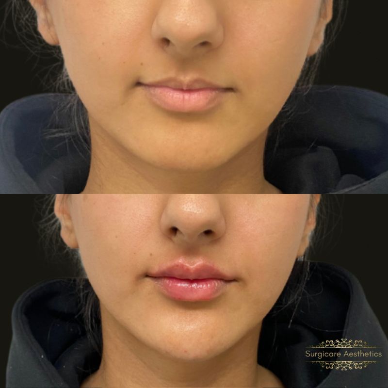 Lip filler in birmingham