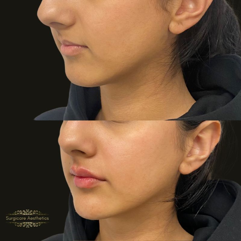 Lip fillers in birmingham