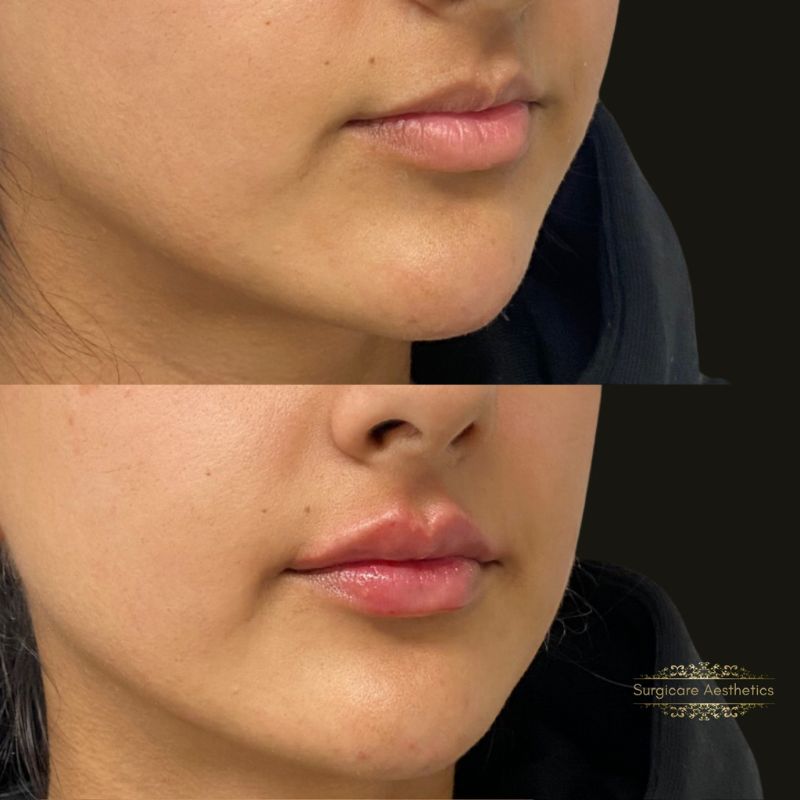 Lip fillers in birmingham