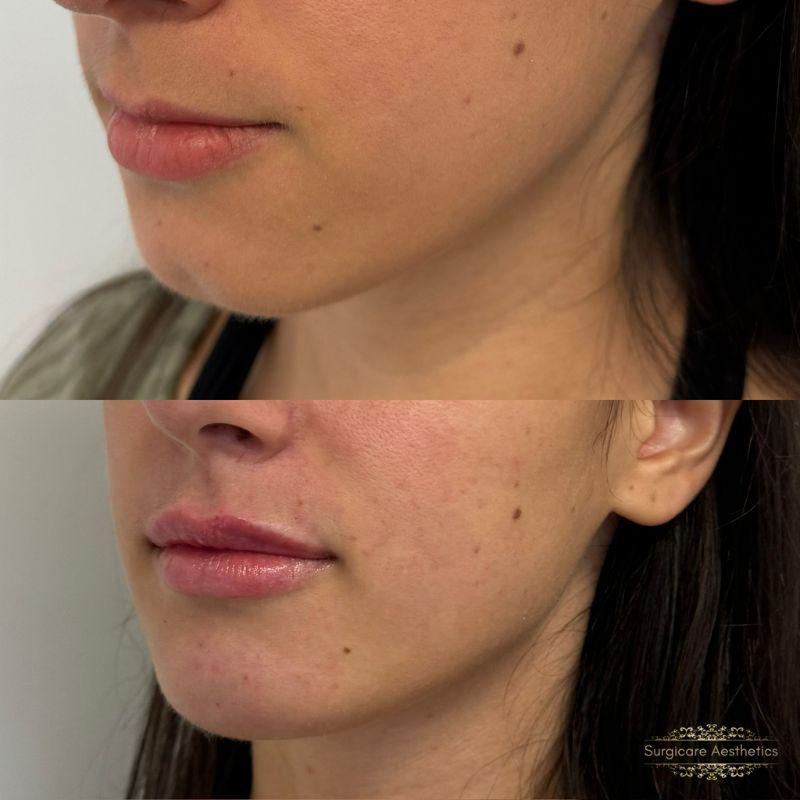 Lip filler in birmingham