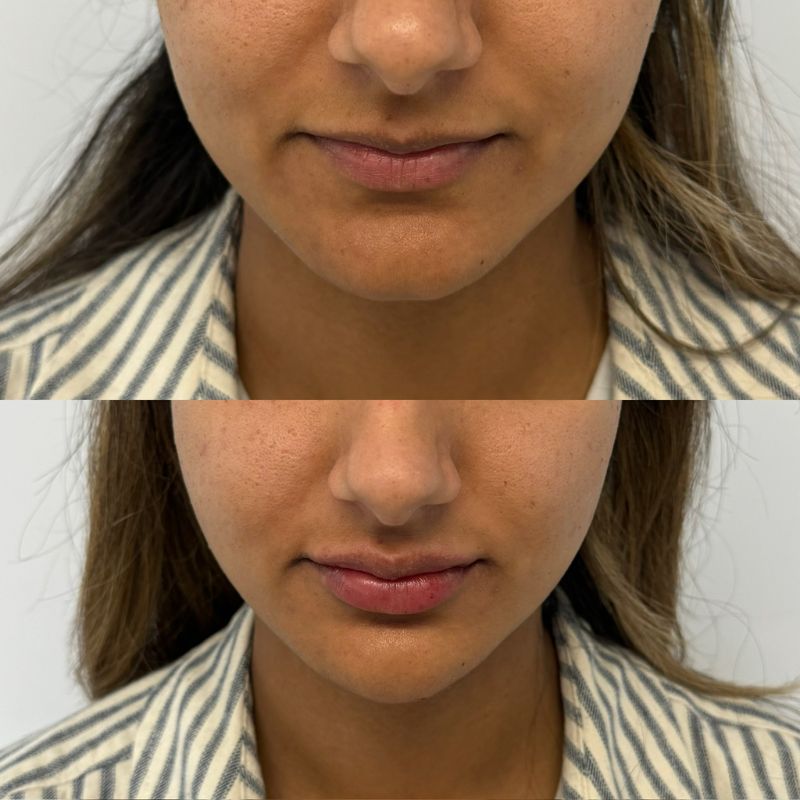 Before and after neogen plasma treatment in Sutton Coldfield 