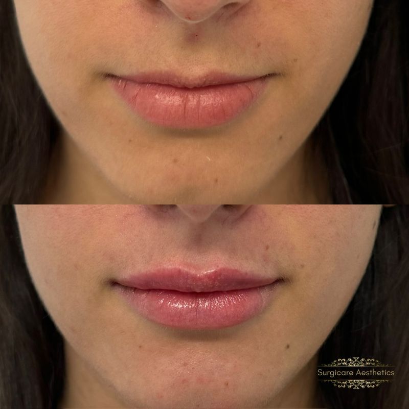 Before and after neogen plasma treatment in Sutton Coldfield 