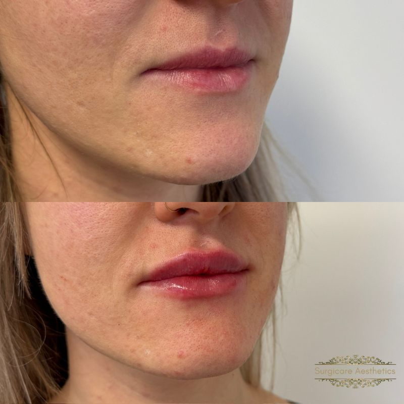 Before and after neogen plasma treatment in Sutton Coldfield 