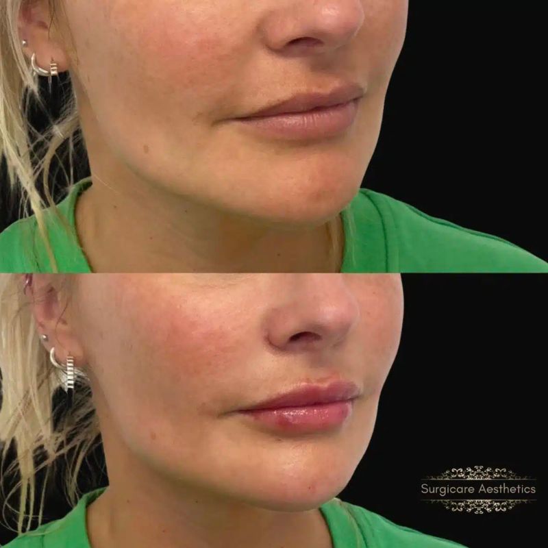 Before and after nasolabial fold filler in Sutton Coldfield 