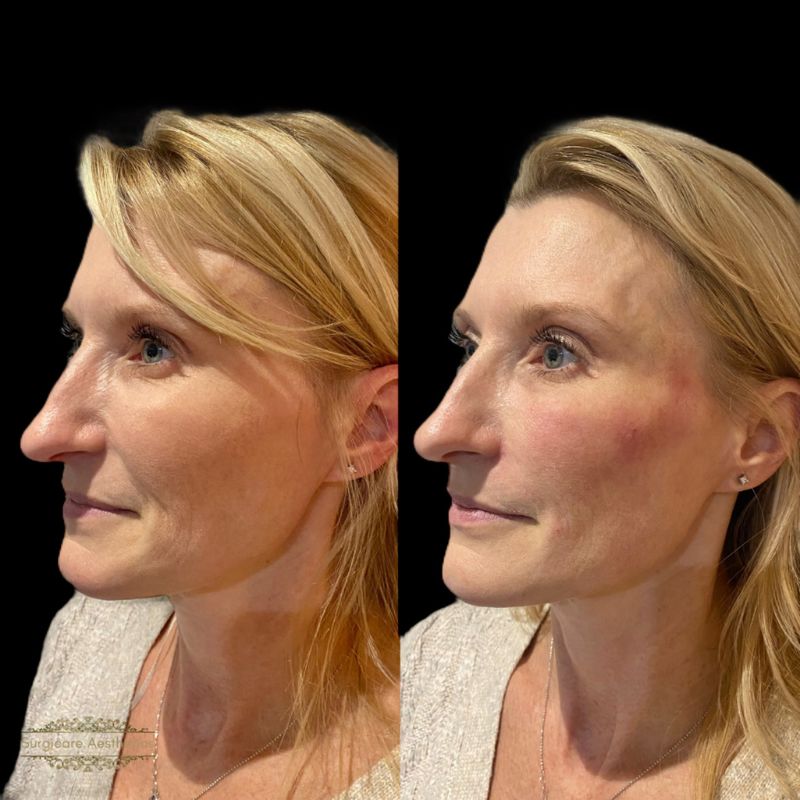 Before and after nasolabial fold filler in Sutton Coldfield 