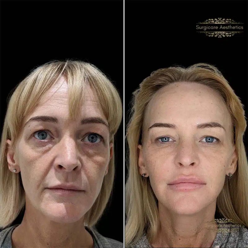 Before and after nasolabial fold filler in Sutton Coldfield 