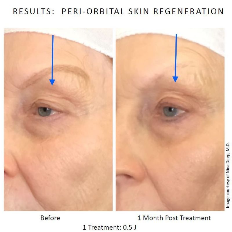 Before and after neogen plasma treatment in Sutton Coldfield 