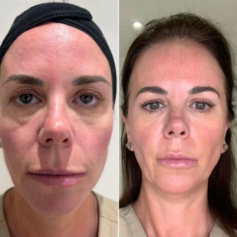 Before and after neogen plasma treatment in Sutton Coldfield 