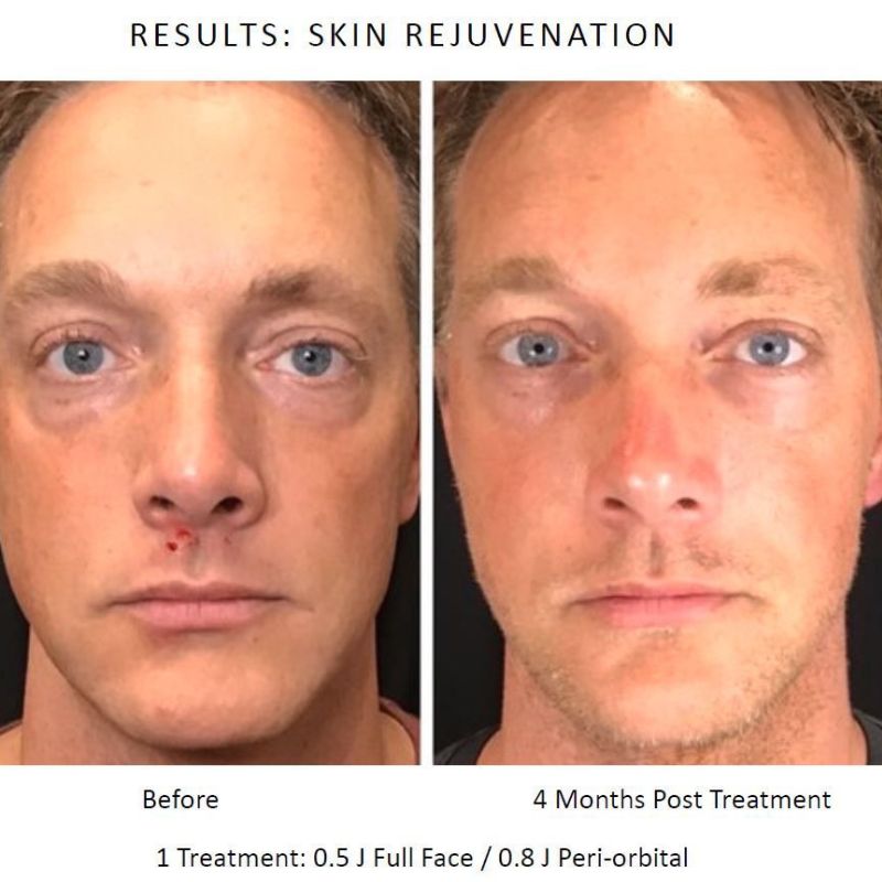 Before and after neogen plasma treatment in Sutton Coldfield 