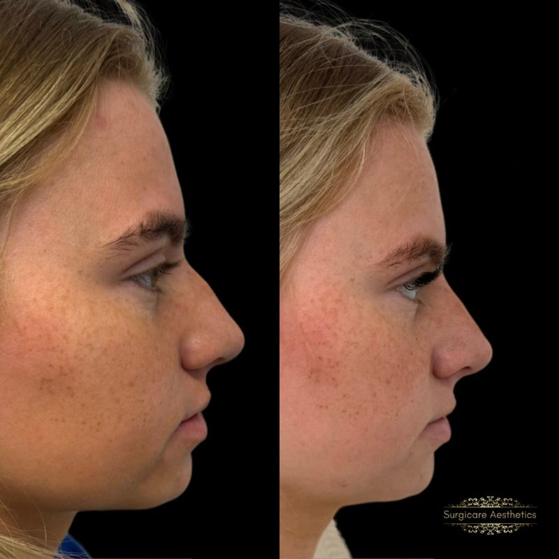 Before and after nose filler in Birmingham