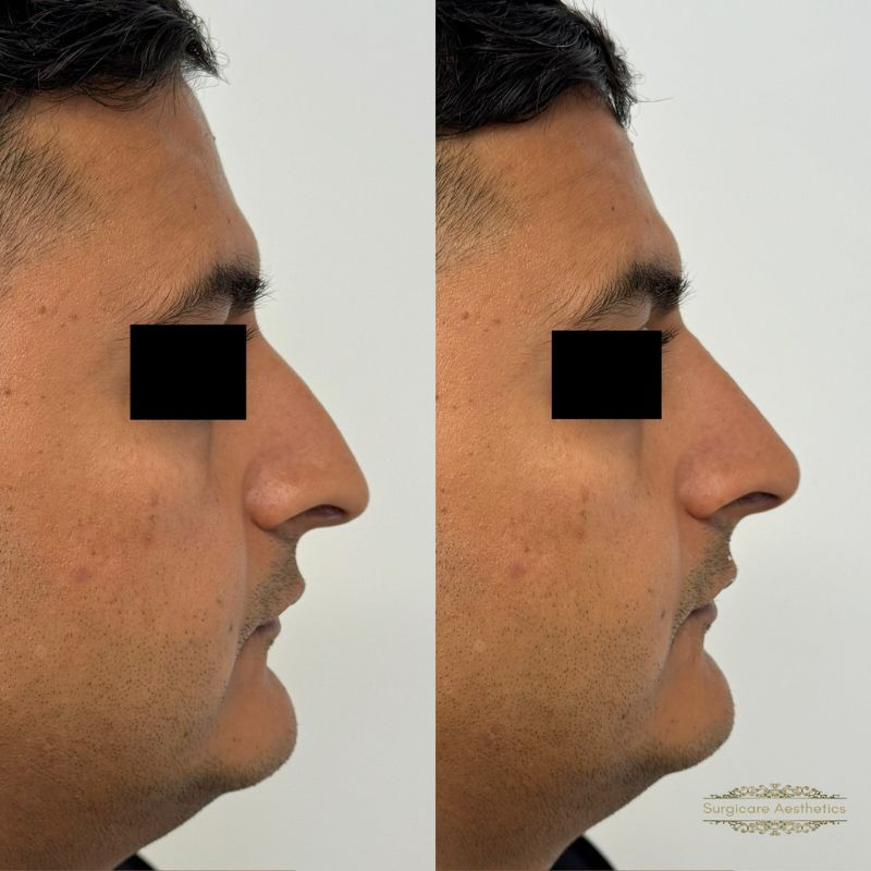 Before and after nose filler in Sutton Coldfield 