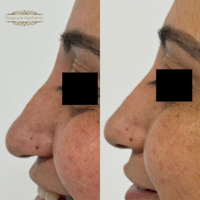 Before and after nose filler in Birmingham