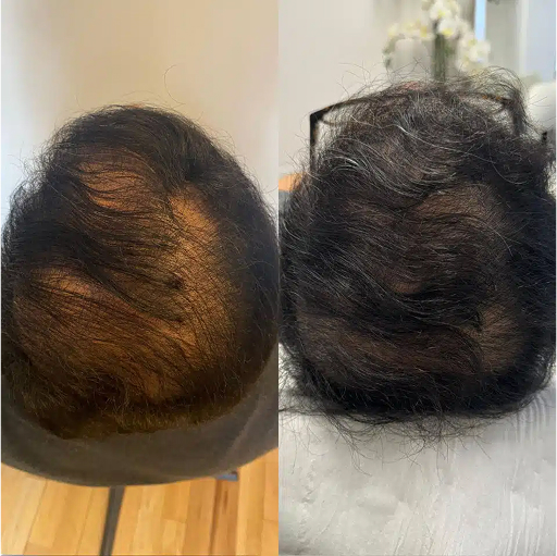 PRP-HAIR-REJUVENATION-ba.jpg