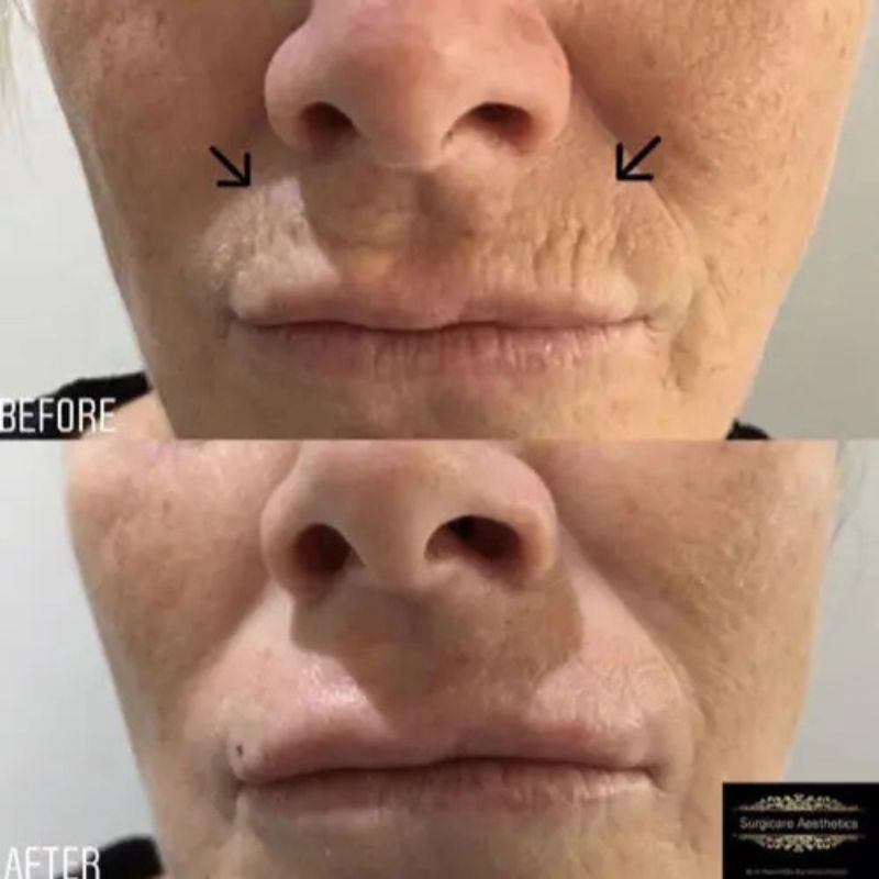 Perioral Lines before and after in birmingham