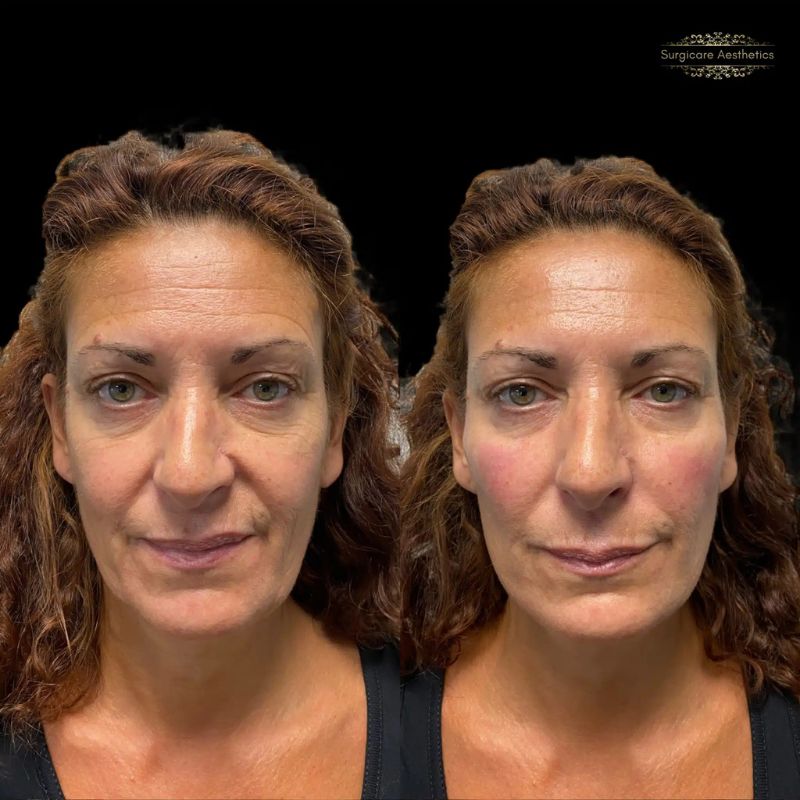 Before and after tear trough filler in Birmingham