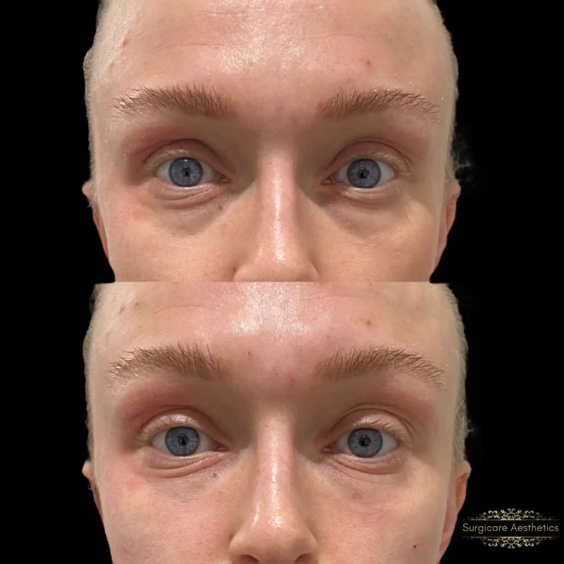 Before and after tear trough filler in Birmingham