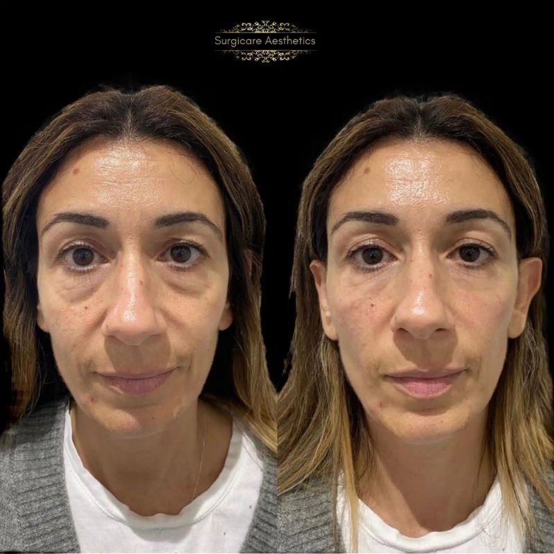 Before and after tear trough filler in Birmingham