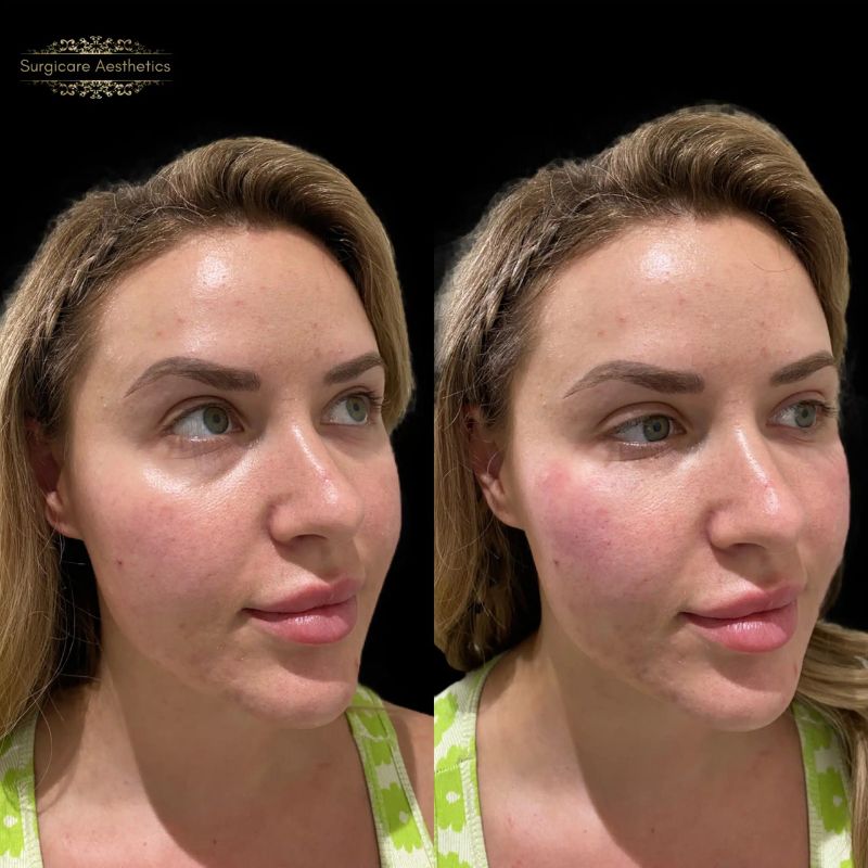 Before and after tear trough filler in Birmingham