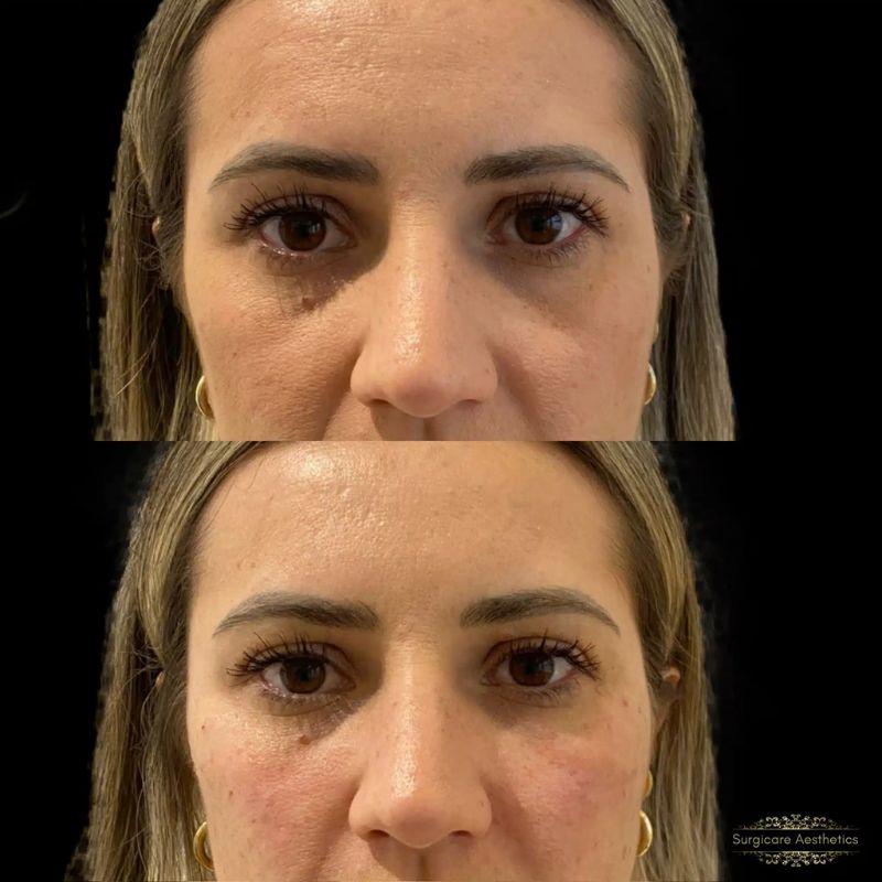 Before and after tear trough filler in Birmingham