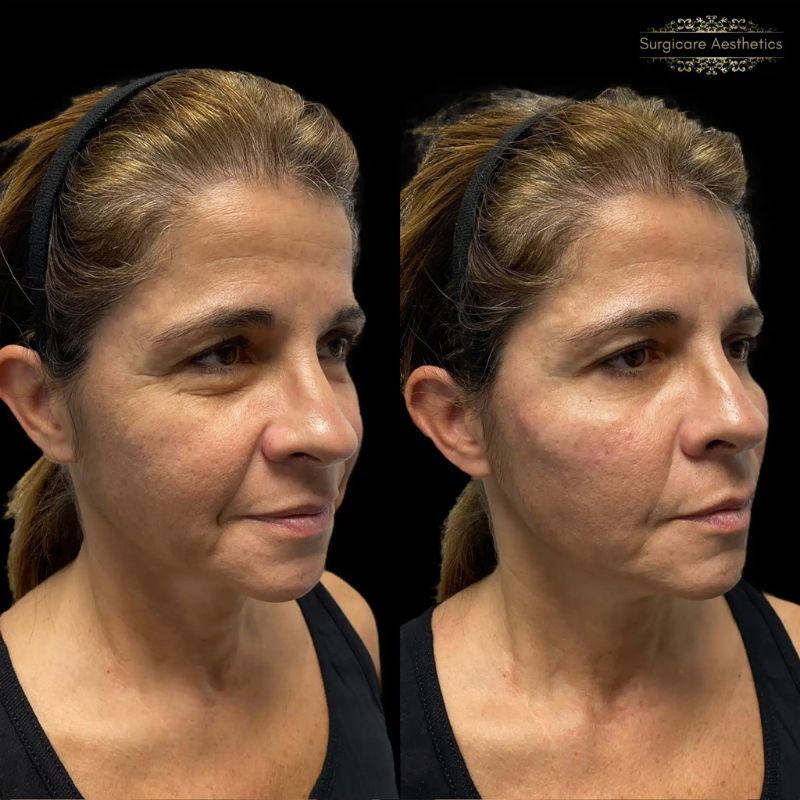 Before and after tear trough filler in Birmingham
