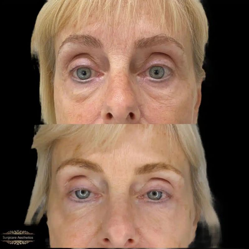 Before and after tear trough filler in Birmingham