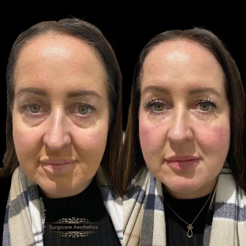 Before and after tear trough filler in Birmingham