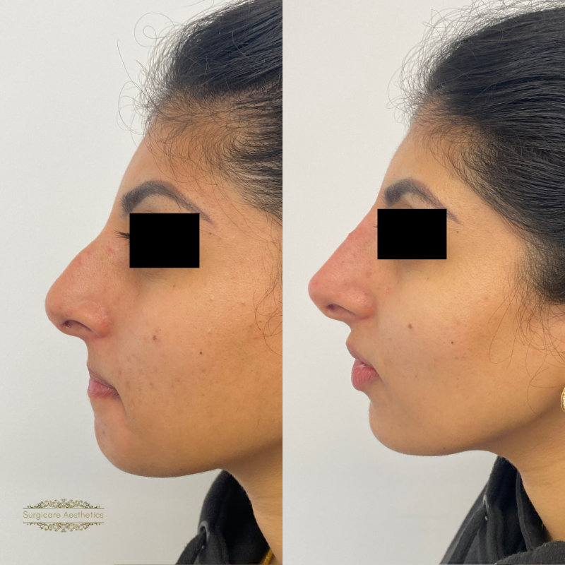 Before and after nose filler in Sutton Coldfield 
