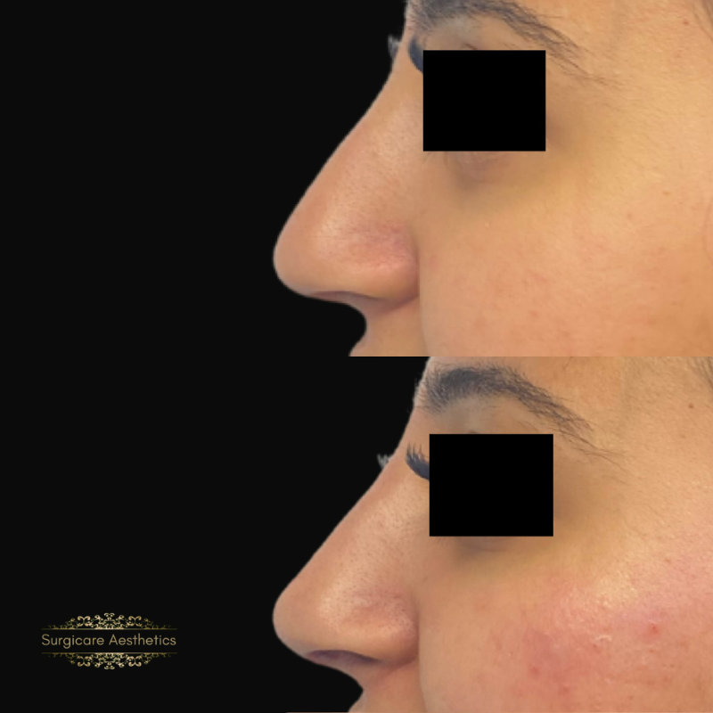 Before and after nose filler in Birmingham