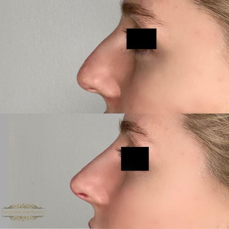 Before and after nose filler in Sutton Coldfield 