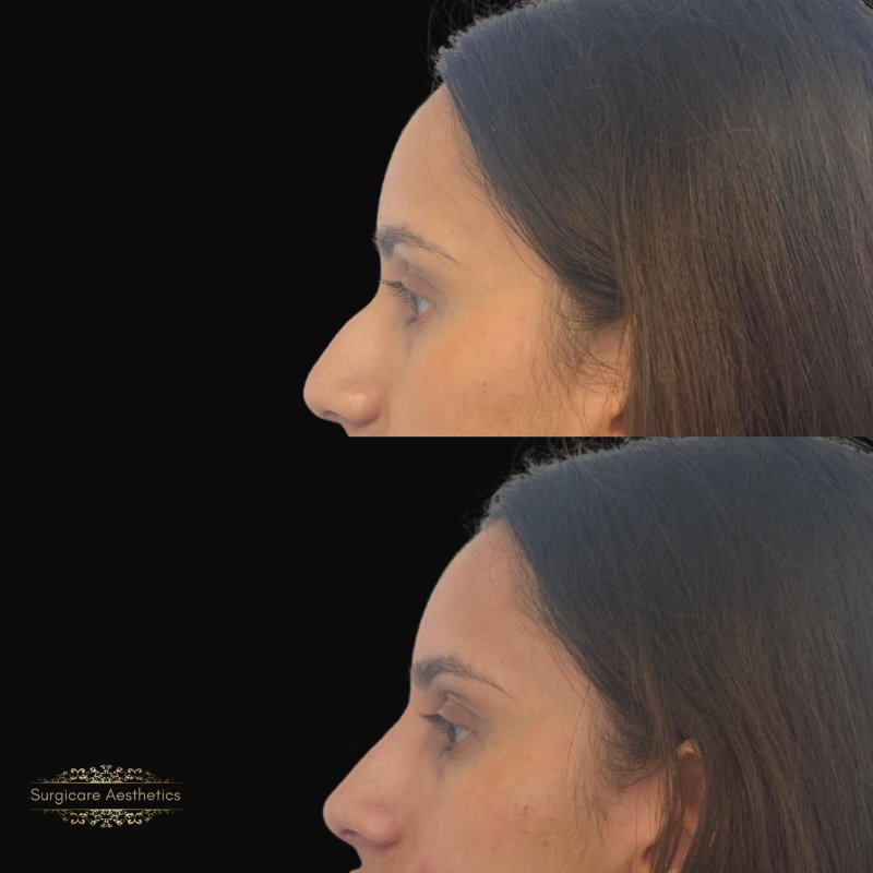Before and after nose filler in Birmingham