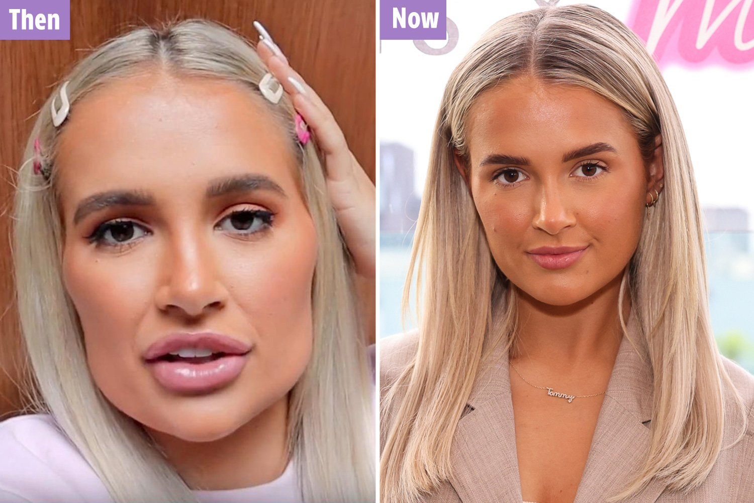 Molly Mae before and after dissolves fillers
